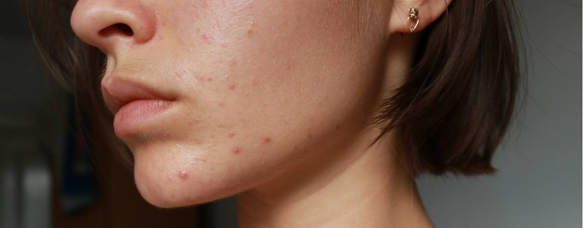 Betekent acne dat u een zwak immuunsysteem hebt?