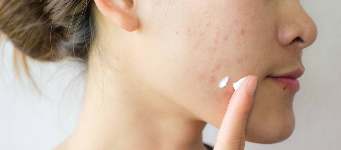 Hoe kan ik acne op natuurlijke wijze voorkomen