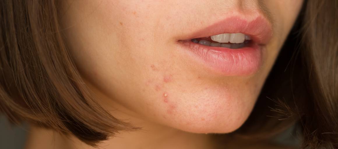 Welke voedingsmiddelen helpen bij acne