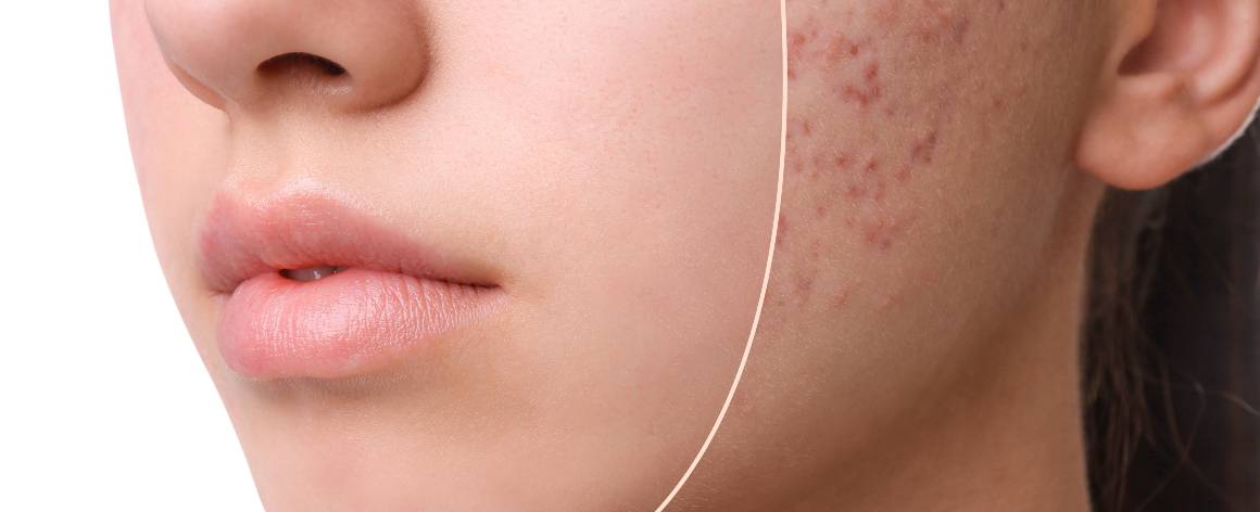 Wat is het verschil tussen acne en puistjes?