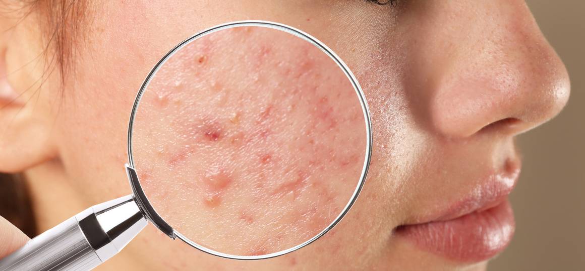 Waarom is het zo moeilijk om van acne af te komen?