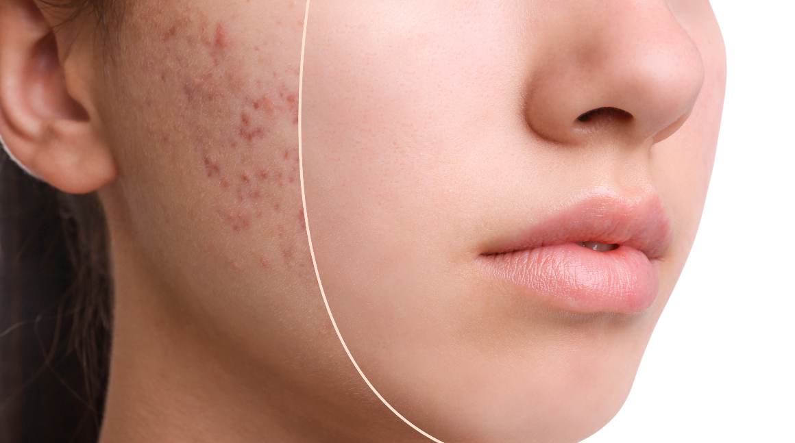 Wat zijn 5 oorzaken van acne