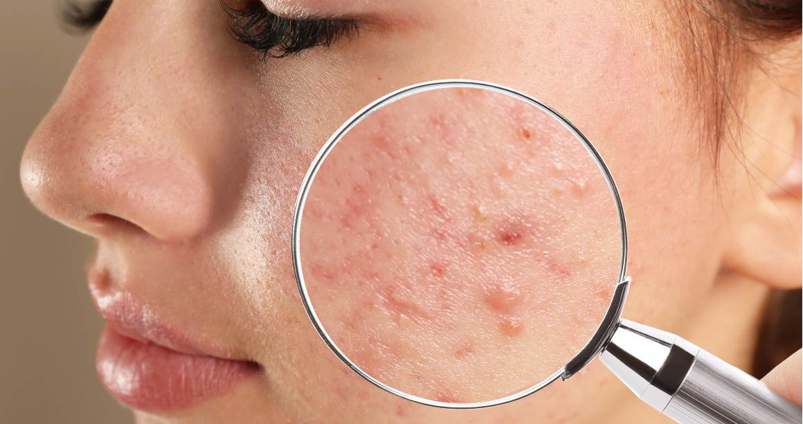 Wat is het verschil tussen puistjes en acne?