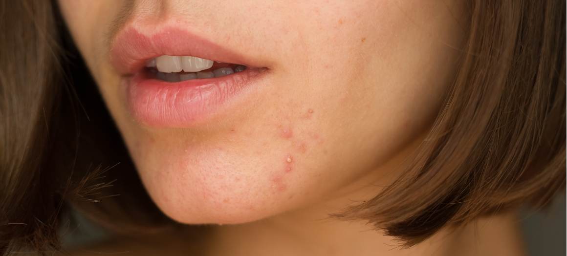 Wat veroorzaakt acne op de kin?