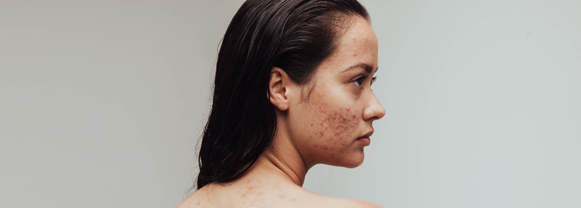 Welke voedingsmiddelen veroorzaken acne De top 9 van acne veroorzakende voedingsmiddelen