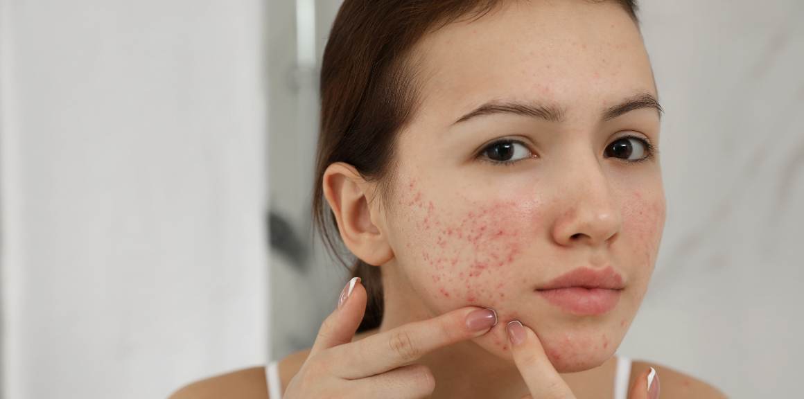 Welk hormoon veroorzaakt acne bij vrouwen?