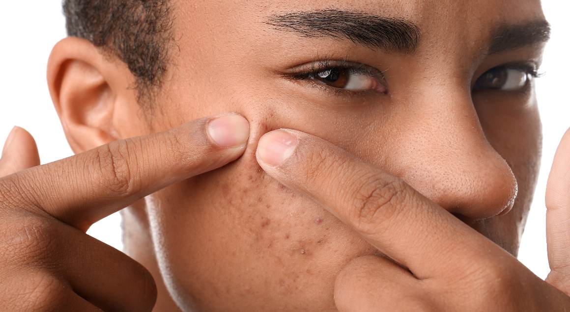 Wat zijn de 2 meest voorkomende vormen van acne