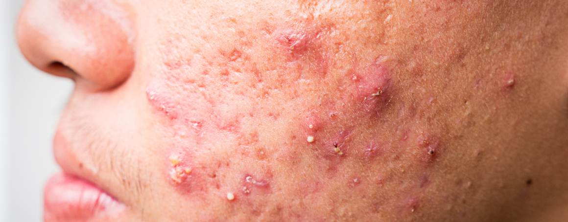 Wat zijn de laatste stadia van acne