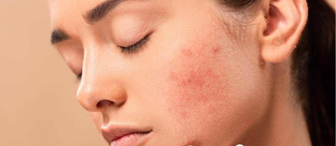 Welk type acne is het moeilijkst te behandelen?