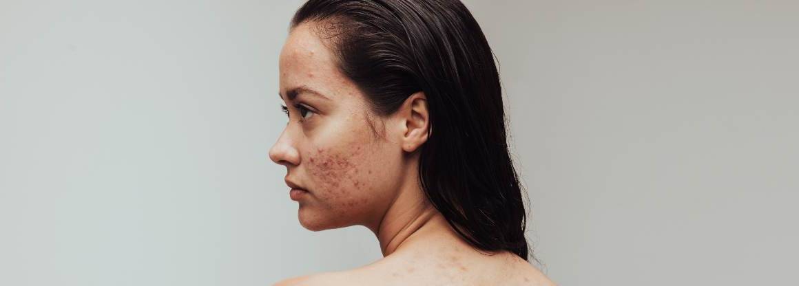 Kan uitdroging acne veroorzaken