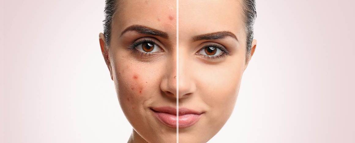 Maakt het wassen van uw gezicht acne erger
