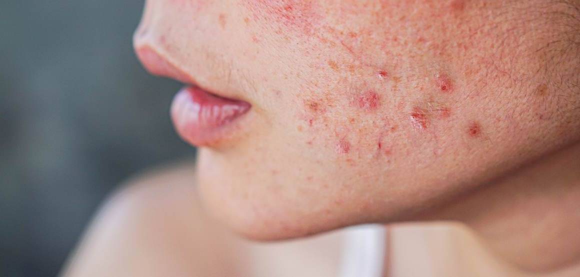 Betekent acne dat u langzamer veroudert