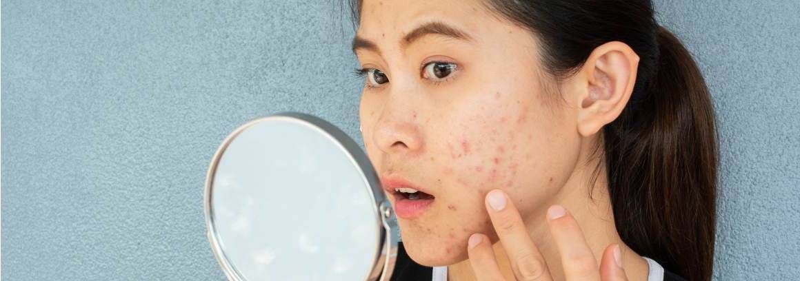 Op welke leeftijd is acne het ergst