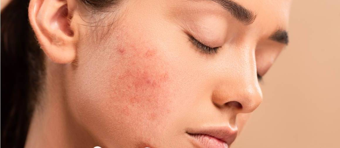 Wat schrijven dermatologen meestal voor bij acne