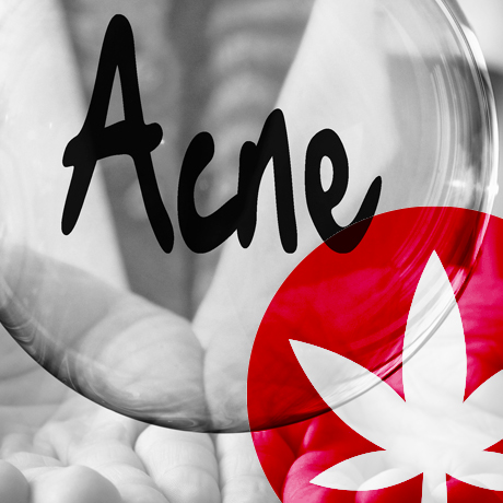 Hoe Kan CBD Helpen Bij De Bestrijding Van Acne?