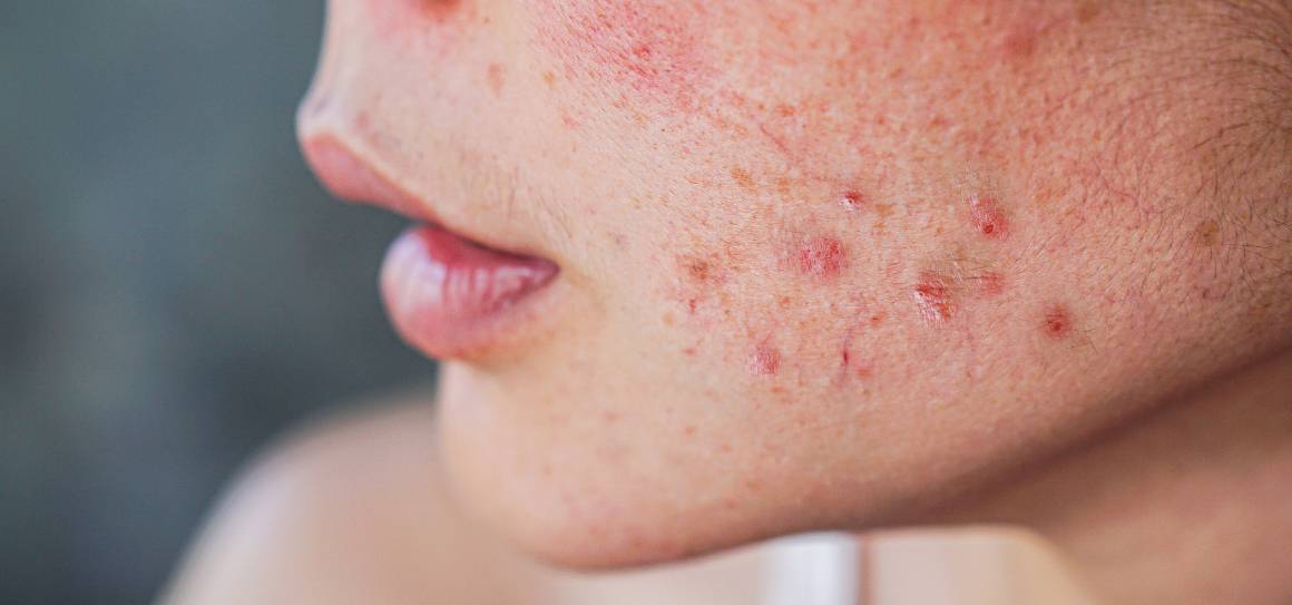 Hoe komen dermatologen van acne af?