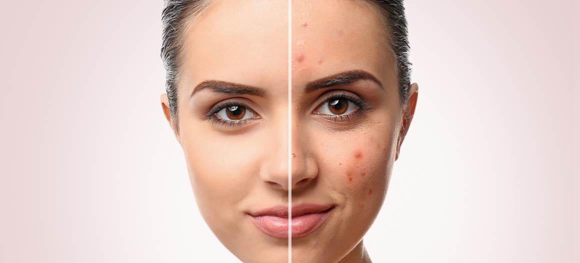 Wat zijn de 4 soorten acne?
