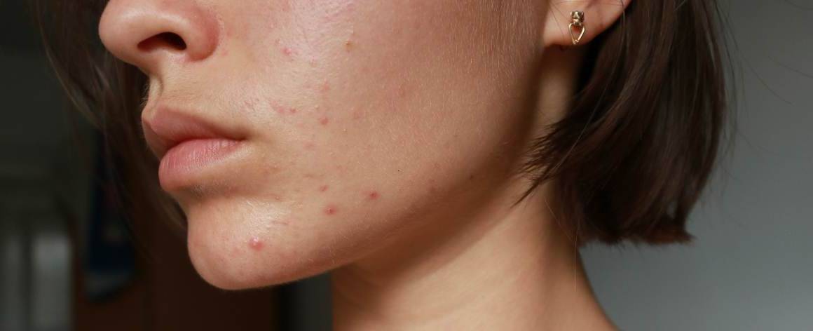 Hoe weet ik of mijn acne hormonaal of door stress komt?