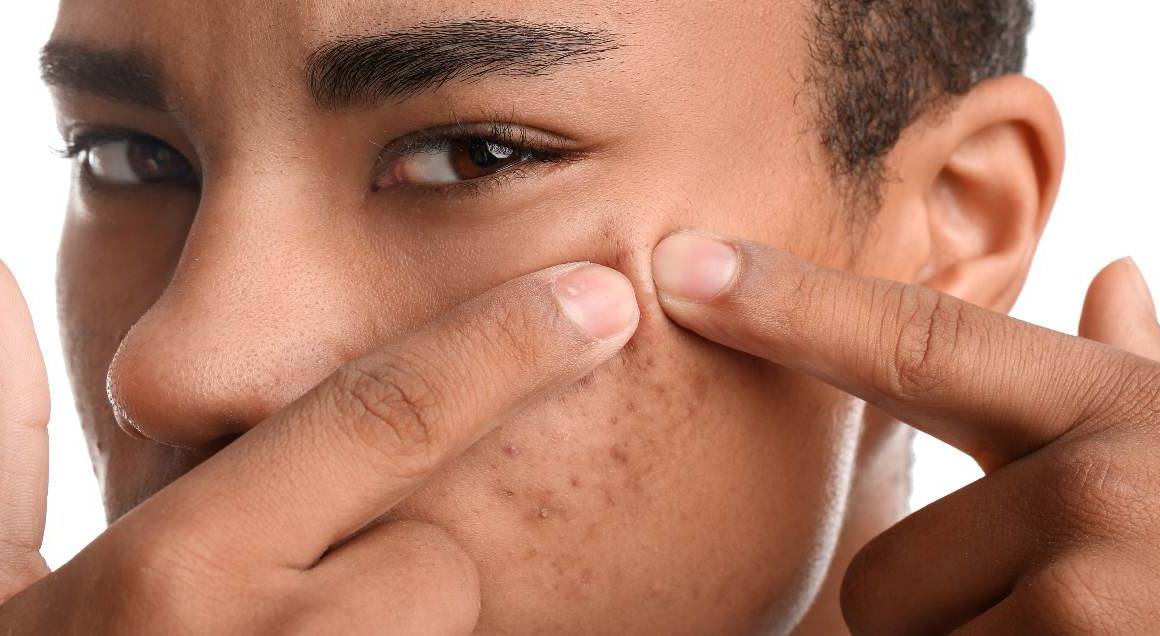 Wat veroorzaakt cysteuze acne?