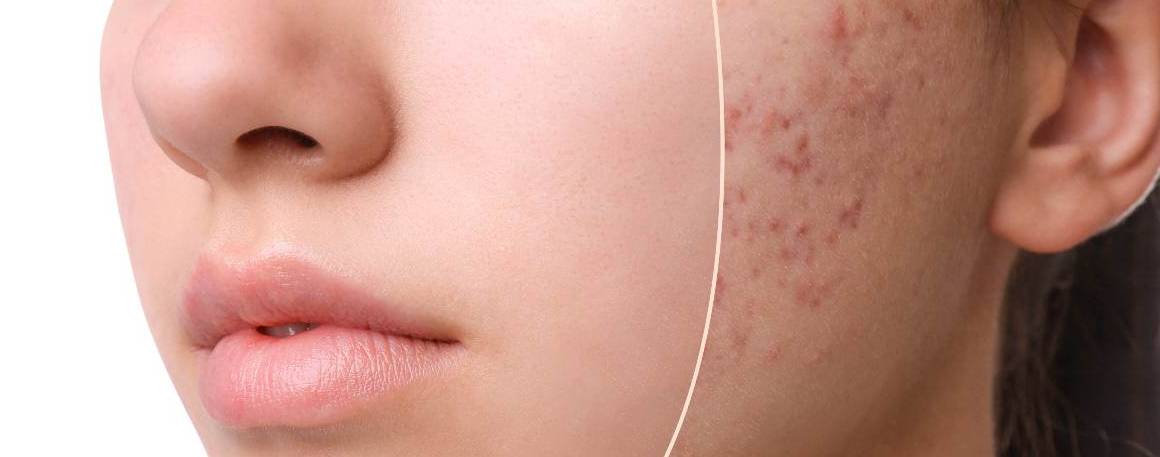 Veroorzaakt slaapgebrek acne?