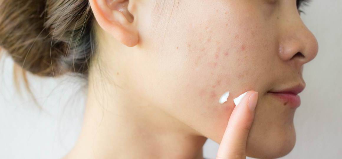 Veroorzaakt suiker acne?