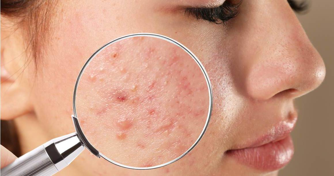 Hoe lang duurt het voordat acne helemaal verdwijnt?