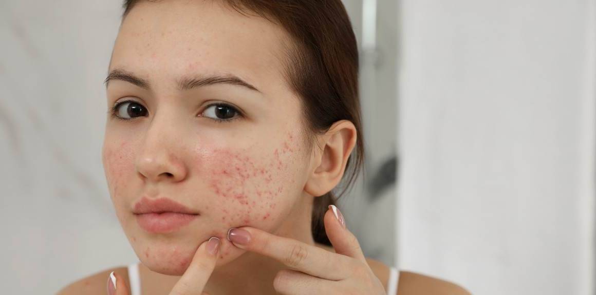 De verrassende voordelen van acne