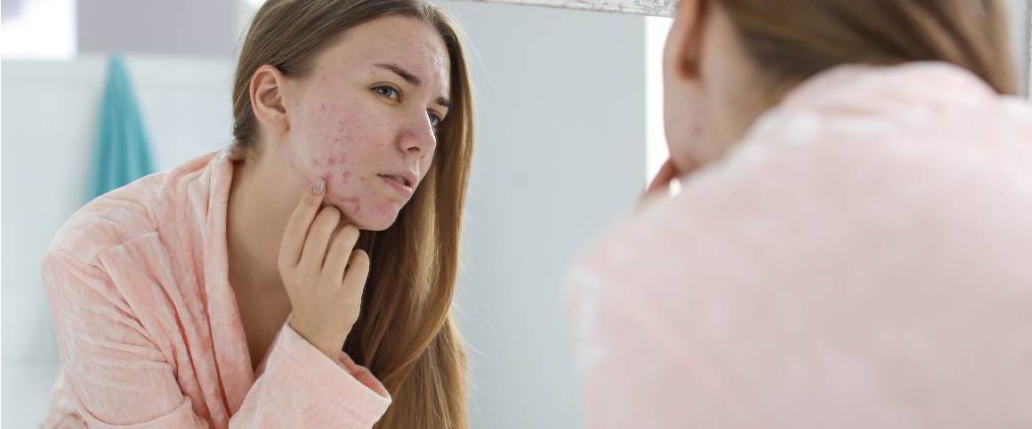 Komt acne terug na Doxycycline?